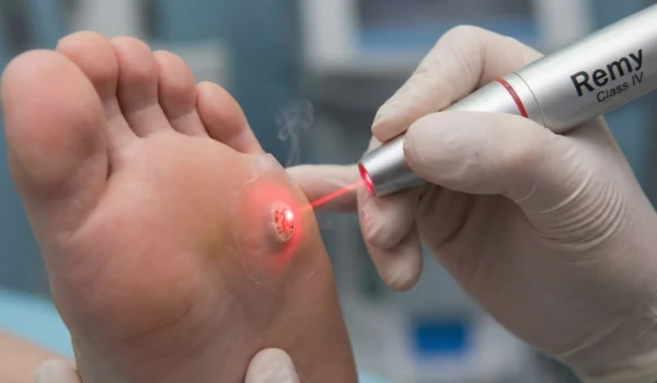 A clinical close-up shot showing a gloved hand holding a sleek silver laser device with "Remy Class IV" printed on the side. A thin, bright red laser beam is precisely targeted at a textured plantar wart on the sole of a foot. Subtle wisps of vapor rise from the treatment site under focused, bright medical lighting.