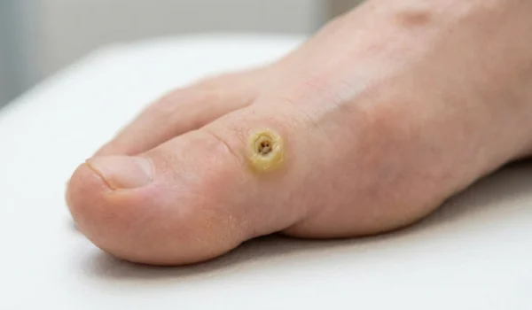 A macro shot under soft, bright light showing a small, yellowish circular corn on a toe; the composition is centered, highlighting the textured keratin core against the natural skin.