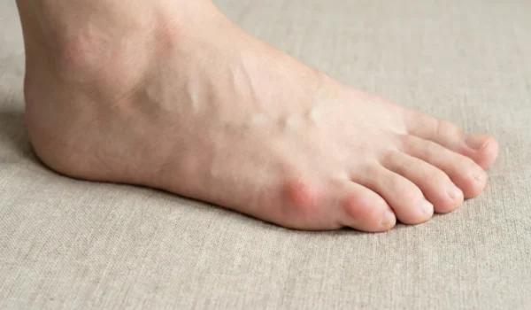 An extreme close-up side profile of a bare human foot resting on a neutral beige textured fabric. A prominent, reddened bony protrusion is visible at the base of the fifth (pinky) toe. The composition is minimalist and tightly cropped to highlight the anatomical deviation. The light is soft and diffused, emphasizing the texture of the skin and the shape of the bump.