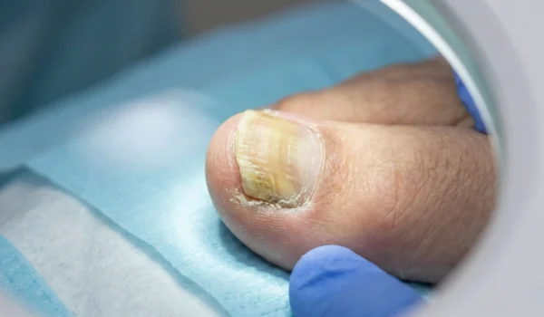 A detailed macro photograph of a big toe with a thick, yellowish, and brittle nail, captured under bright, white clinical light from a circular magnifying lamp. The scene is framed by blue-gloved hands of a medical professional against a soft blue backdrop, emphasizing the texture and discoloration of the nail plate.